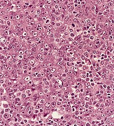 Undifferentiated nasopharyngeal carcinoma—high power[[