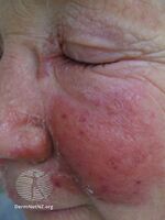 DermNet NZ erysipelas-005.jpg