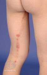 Lichen striatus (DermNet NZ dermatitis-striatus5).jpg