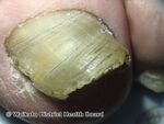 Onychomycosis, toenail (DermNet NZ Onychomycosis-2-v2).jpg
