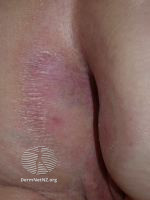 Perianal lichen sclerosus (DermNet NZ 084-small).jpg