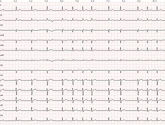ECG sinus arrhythmia.jpg