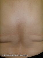 Macular amyloidosis