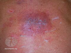 Wound infection -bacterial