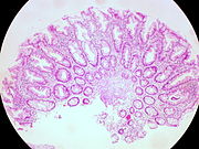 Hyperplastic Polyp of the Rectum (14060044206).jpg