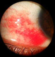 As viewed through a slit lamp