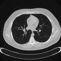 Chest CT (axial lung window)