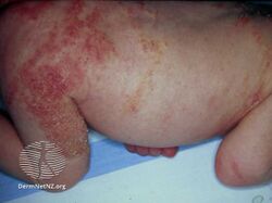 Incontinentia pigmenti