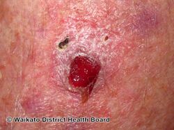 Atypical fibroxanthoma