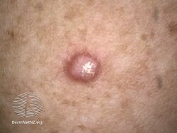 Macro view of histologically confirmed atypical fibroxanthoma