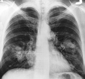 X-ray chest cancer.jpg