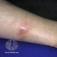 Erythema induratum
