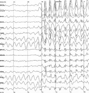 Epileptic spike and wave discharges monitored with EEG