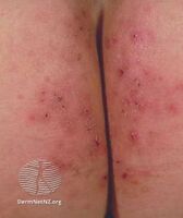 Dermatitis herpetiformis