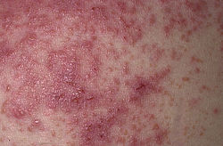 Its characteristic rash resembles herpes and is the basis of its clinical name