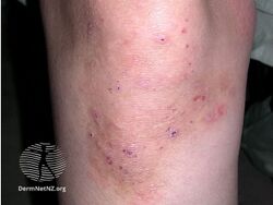 Dermatitis herpetiformis