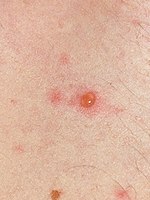 Chickenpox blister.jpg