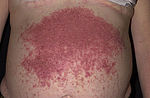 Dermatitis-herpetiformis.jpg