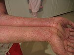 Eczema-arms.jpg