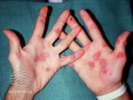 Erythema multiforme (DermNet NZ reactions-multiforme4).jpg