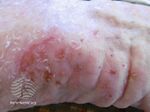 Excoriations in scabies (DermNet NZ scabies-022).jpg