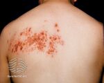 Herpes zoster (DermNet NZ viral-zoster-14).jpg