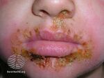 Impetigo on the mouth. (DermNet NZ perioral-impetigo-18).jpg