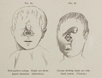 Cyclopia fetuses.jpg