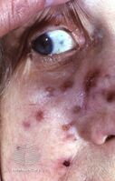 Cutaneous tuberculosis