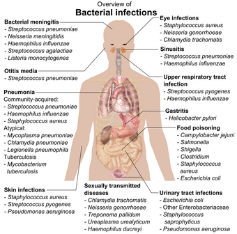 chart showing bacterial infections upon various parts of human body