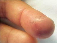 Osler node finger tip.png