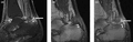 (a) STIR Sagittal MRI of ankle showing enthesitis at Achilles tendon insertion (thick arrow), synovitis of ankle joint (long thin arrow), and bone marrow edema at tendon insertion (short thin arrow). T1-weighted images, before (b) and after (c) contrast, show enthesitis (large arrow) and bone erosion at tendon insertion (short thin arrows).