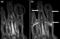 Coronal T1-weighted MRI of fingers in PsA. (a) Pre- and (b) post-contrast showing active synovitis at proximal and distal interphalangeal joints (large arrows), joint space narrowing, bone proliferation at proximal interphalangeal joint, erosions at distal interphalangeal joint (white circle), enthesitis medial to proximal interphalangeal joints.