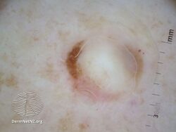 Desmoplastic melanoma