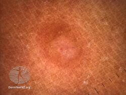 Desmoplastic melanoma