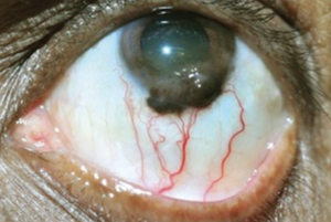Conjunctival melanoma.png