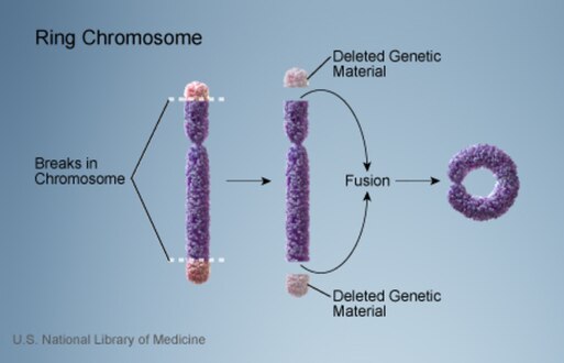 Formation of a ring chromosome.