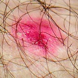 A patch of dermatitis that has been scratched