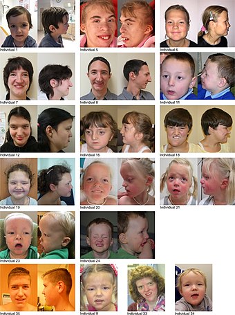 Individuals who have Snijders Blok-Campeau syndrome.jpg