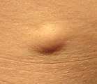 lipoma[8]
