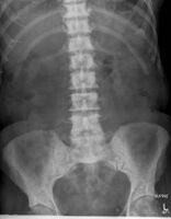 Bony metastases from prostate cancer