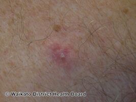 Primary cutaneous adenoid cystic carcinoma