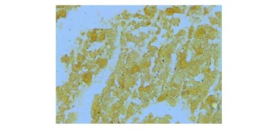 Bartonella henselae was demonstrated by Warthin-Starry silver stain