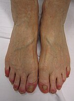 Chilblains from excessively icing the feet.jpg
