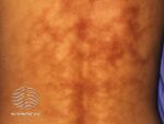 Erythema ab igne (DermNet NZ reactions-igne2).jpg