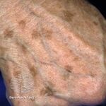 Solar lentigo (DermNet NZ lesions-s-solar-lentigo-01).jpg