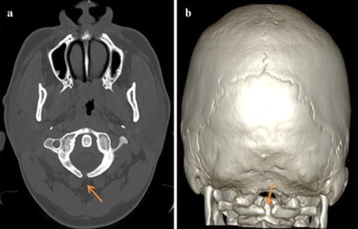 a,b) Atlas spina-bifida oculta