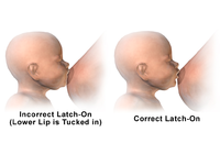 Breastfeeding – Incorrect vs correct latch-on.