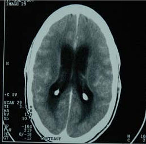 Tuberculous-meningitis-scan.jpg