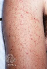 Meningococcal petechiae